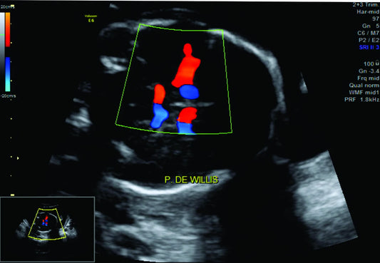 Perfil Hemodinámico Doppler Fetal