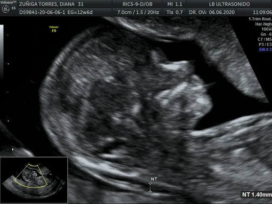 Marcadores Cromosómicos 11-14