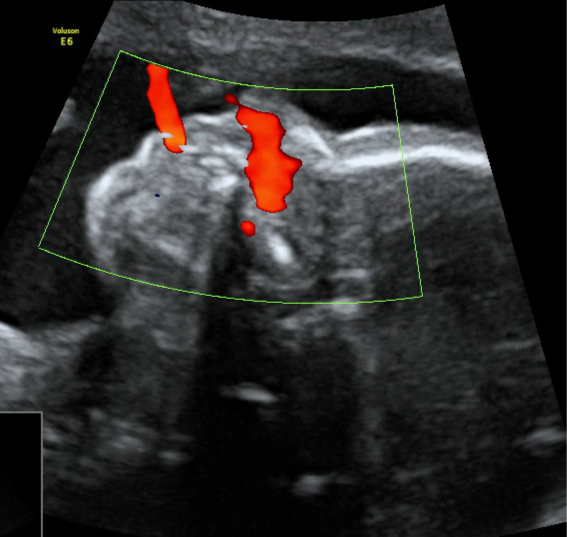 Perfil Hemodinámico Doppler Fetal