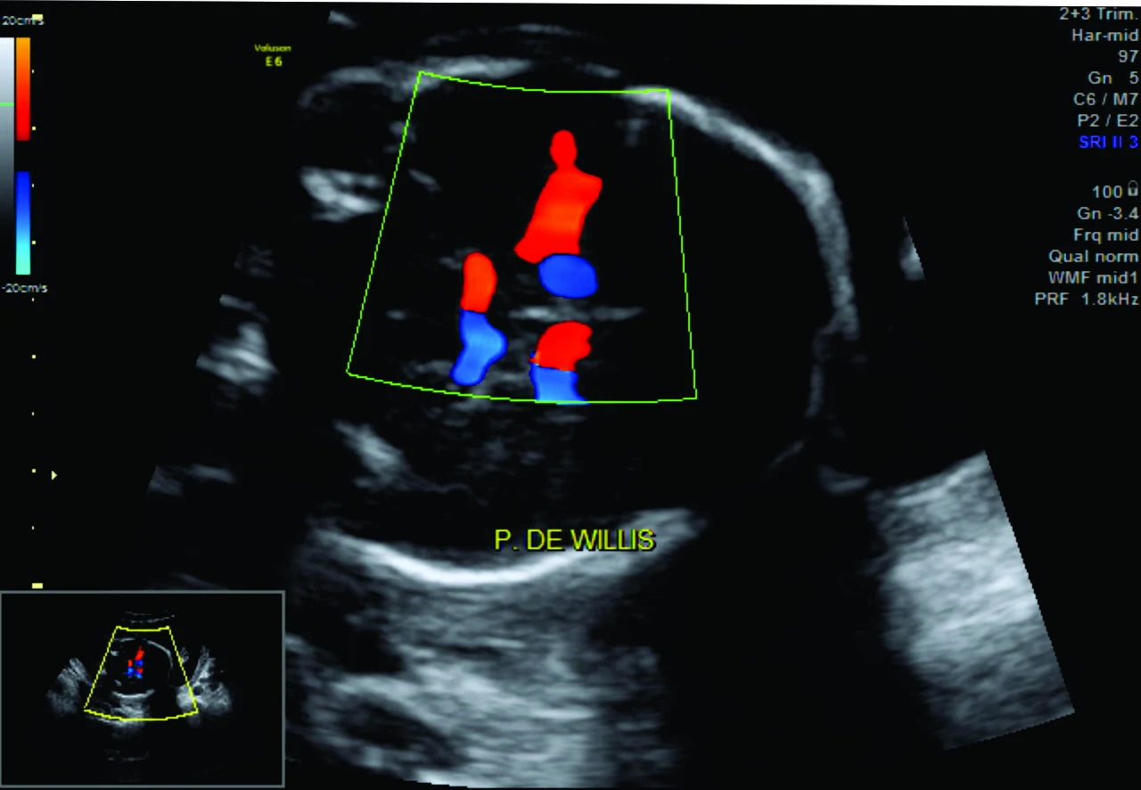 Perfil Hemodinámico Doppler Fetal