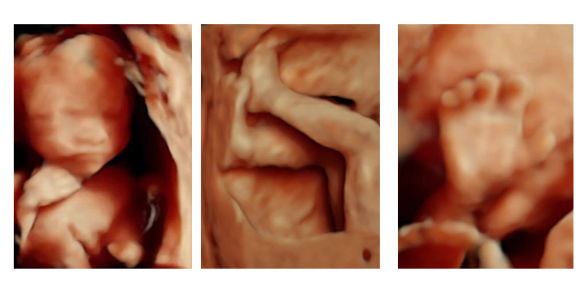 Ultrasonido Estructural 4D del Segundo Trimestre